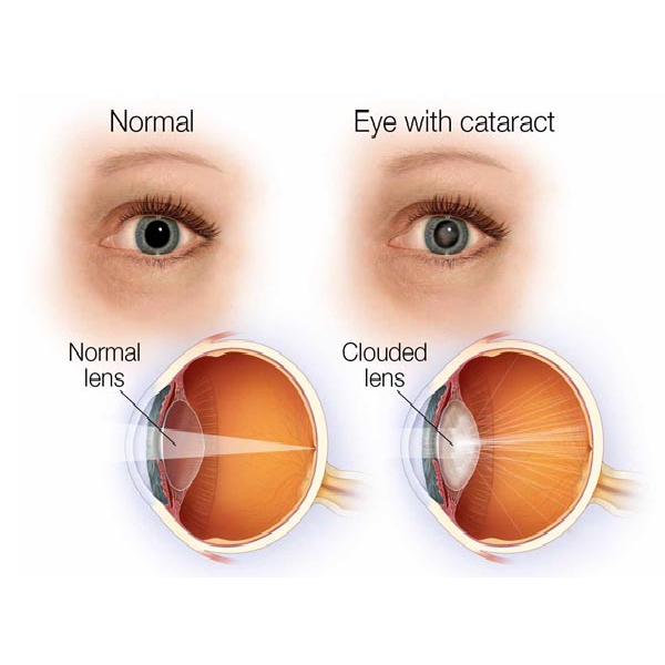 Cataract