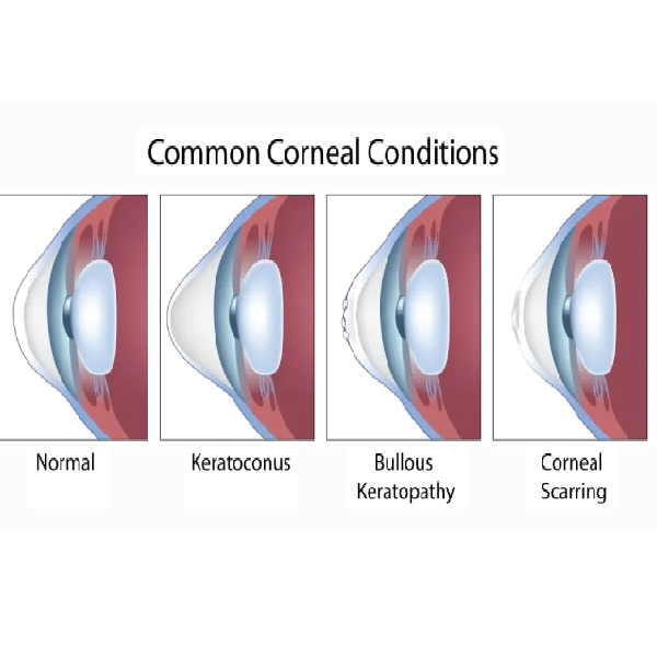 Cornea