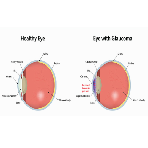 Glaucoma