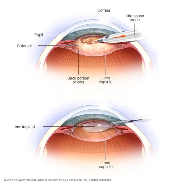 Cataract Treatment