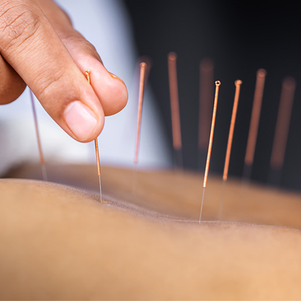 Acupuncture