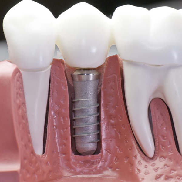 Dental Implants