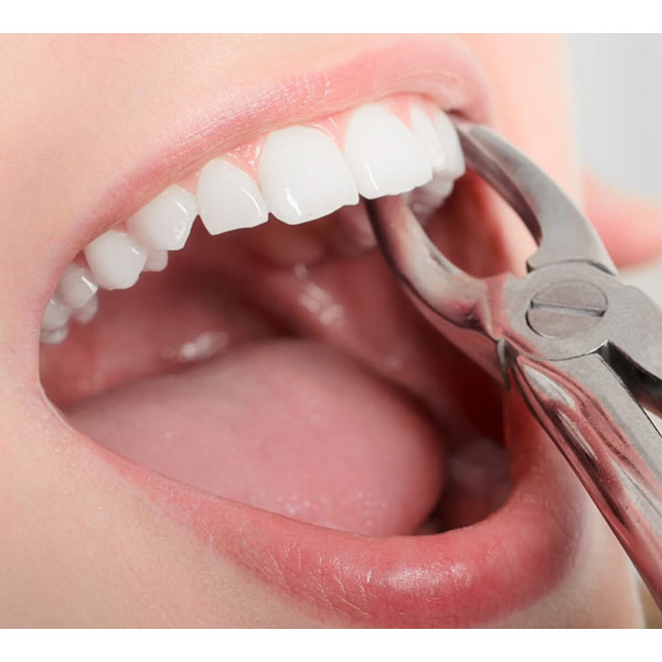 Tooth Extraction