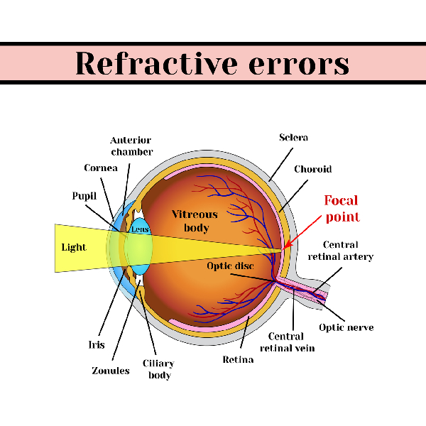 Refractive Errors