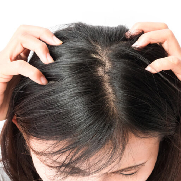 Hair Anti-dandruff Treatment