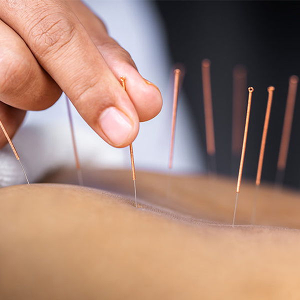 Acupuncture