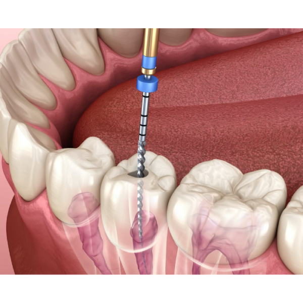 Root Canal Treatment