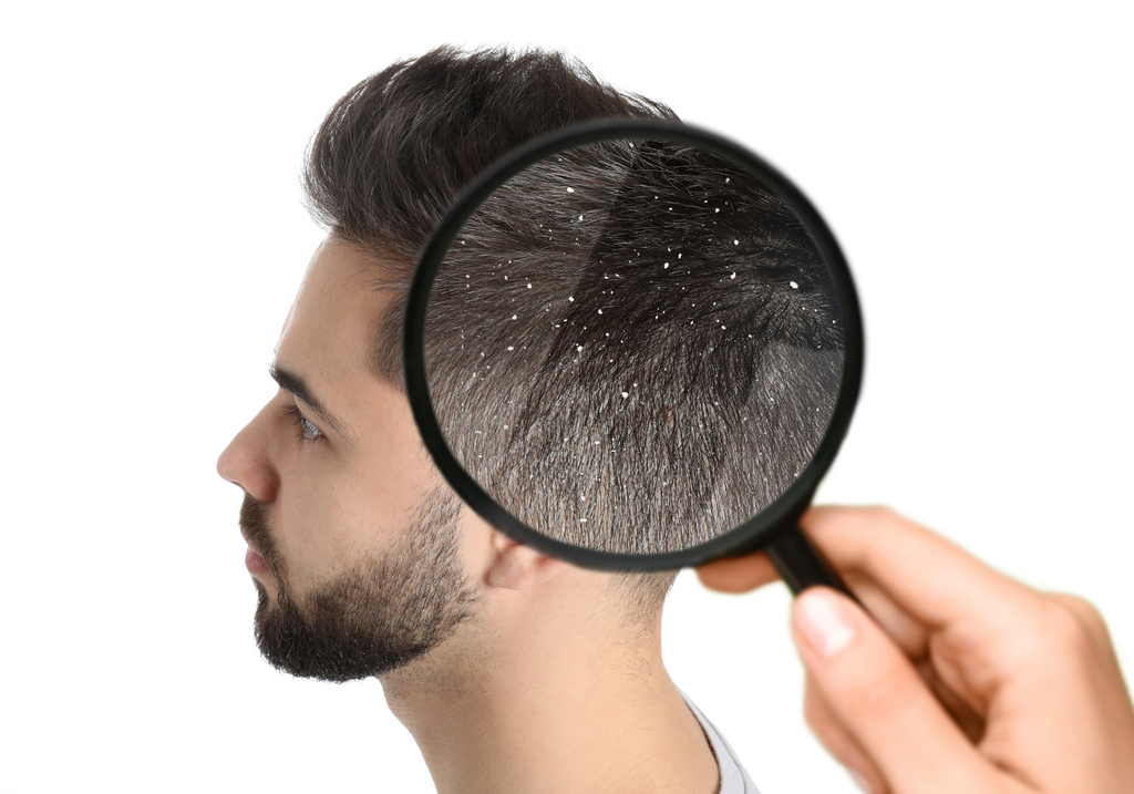 Dandruff Treatment