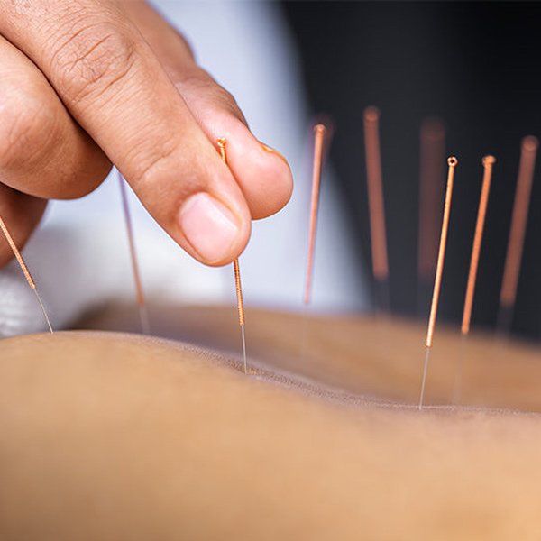 Pacess Wellness India LLP+Acupuncture